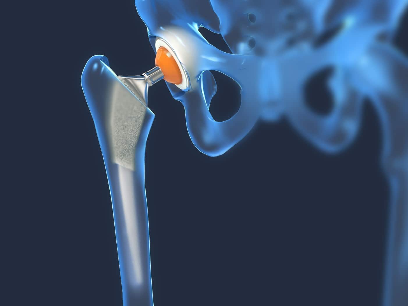 Hip Replacement Systems